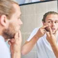 What are the best treatments for acne in men?