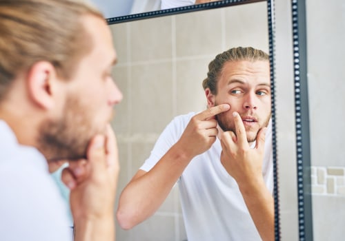 What are the best treatments for acne in men?